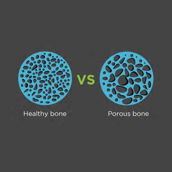 Healthy bone vs porous bone